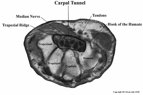 Mri Carpal Tunnel