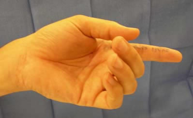 Index finger has both tendons cut