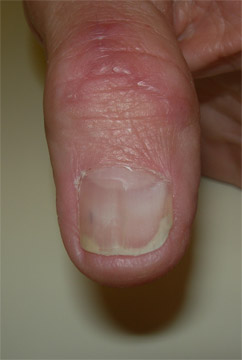 mucous cyst: nail growing back normally