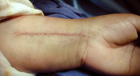 Incision after surgery