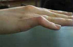 A boutonniere finger is a complex imbalance between the tendons of the finger.