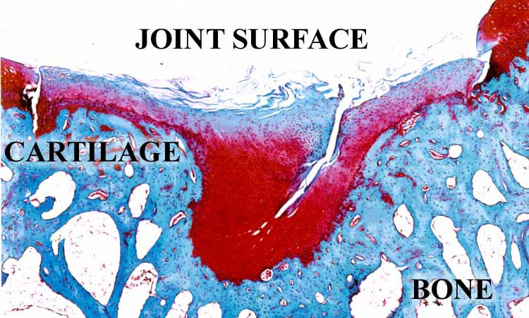 Photomicrograph cartilage with arthritis