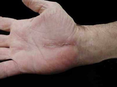 Dupuytren's contracture - Wikipedia