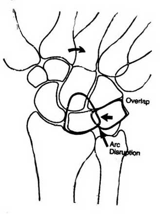 Wrist Arthrography Technique