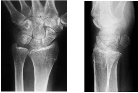 broken hand bones xray