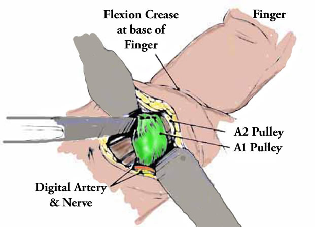 Trigger Finger: Practice Essentials, Background, Anatomy